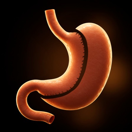 Laparoscopic Gastric Sleeve surgery